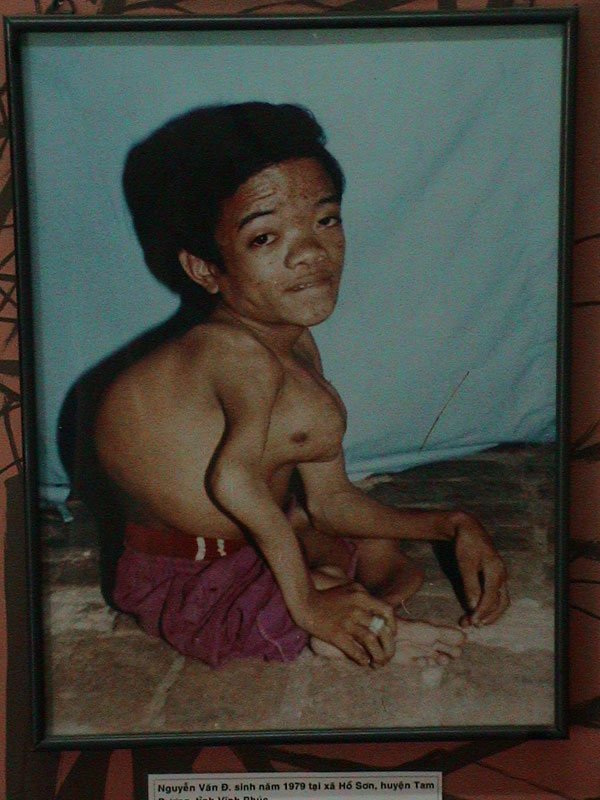 Deformed-Victim-of-AGENT-ORANGE.jpg